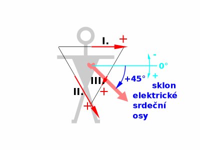 800px-ECG-Einthoven-vect6-sklon_osy45.svg