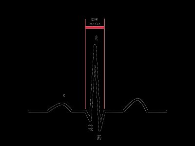 800px-ECG-PQRSkomplexT.svg
