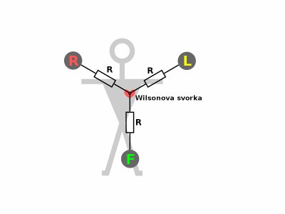800px-ECG-Wilson-R.svg