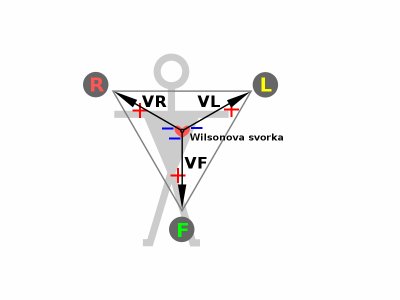 800px-ECG-Wilson.svg
