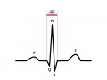 800px-ECG-PQRSkomplexT.gif
