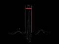 800px-ECG-PQRSkomplexT.svg.gif