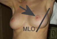 mammo_MLO.png